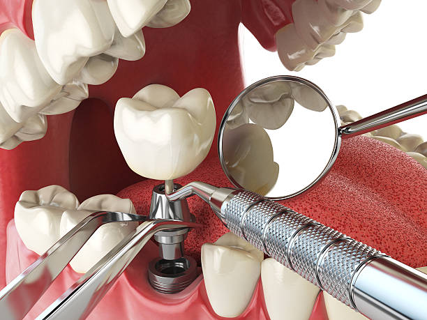 Best Emergency Root Canal Treatment in Shadow Lake, WA